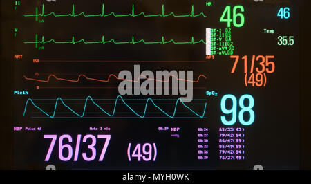 Ein Monitor mit einem schwarzen Bildschirm mit einer langsamen Herzfrequenz auf dem EKG, niedriger Blutdruck auf der arteriellen Linie und Sauerstoffsättigung auf der blauen Linie. Stockfoto