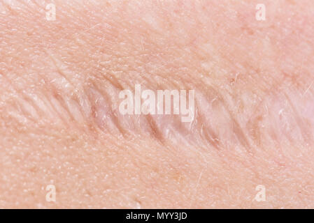 KELOIDE NARBEN Stockfoto, Bild: 52252520 - Alamy
