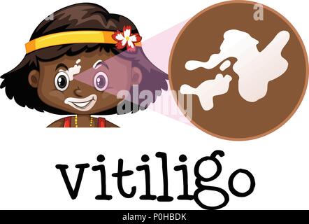 Die medizinische Ausbildung von Vitiligo Abbildung Stock Vektor