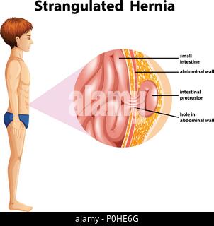 Eine menschliche Anatomie stranguliert Hernie Abbildung Stock Vektor