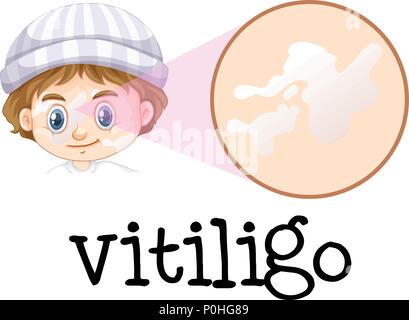 Ein Junge mit Vitiligo Abbildung Stock Vektor