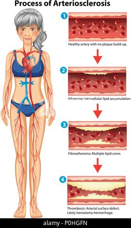 Prozess der Arteriosklerose medizinischen Abbildung Stock Vektor
