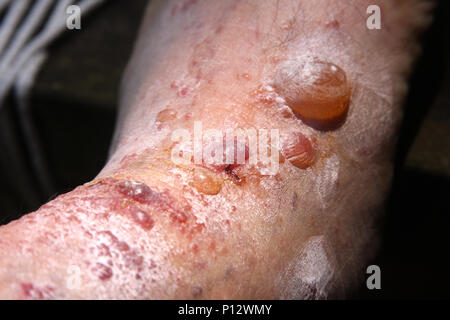 Nahaufnahme von Blasen auf dem Arm des Menschen, durch die allergische Reaktion auf Poison Ivy verursacht Stockfoto