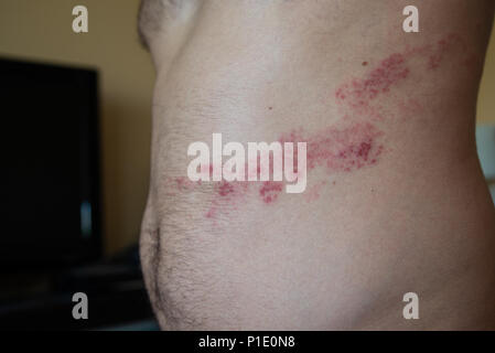 Auf Herpes zoster in der Nähe auf dem Magen Stockfoto