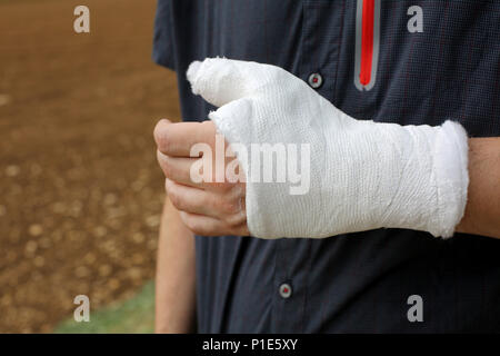 Hand einer Person mit dem Daumen und Handgelenk vollständig verputzt nach dem Bruch der Knochen Stockfoto