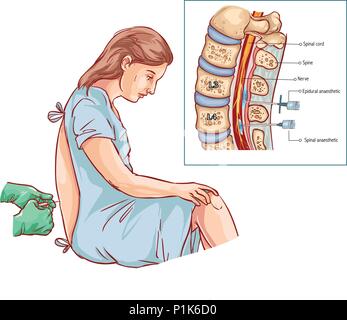 Epidurale Nervenblockade Injektion Stock Vektor