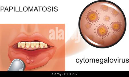 Vector Illustration der oralen Schleimhaut- papillomatose. cytomegalovirus Stock Vektor