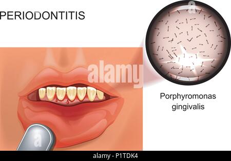 Vector Illustration von Parodontitis. Zahnfleischbluten. Stomatologie Stock Vektor