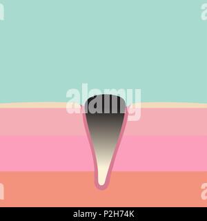 Vector Illustration von blackhead Strukturbild - hautschichten Seite ausschneiden und Anatomie einer Pore mit bakteriellen Mitesser Akne verstopft. Stock Vektor