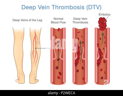 Medizinische Darstellung von tiefen Venenthrombosen im Beinbereich. Stock Vektor