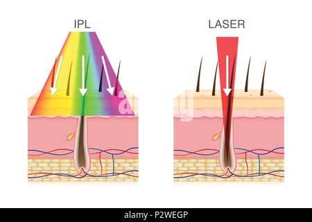 Der Unterschied bei der Verwendung von IPL Licht und Laser Haarentfernung. Stock Vektor