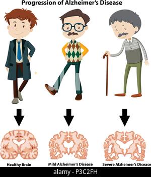 Ein Fortschreiten der Alzheimer-krankheit Abbildung Stock Vektor