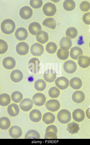 Rote Blutzellen infiziert mit dem Malariaparasiten. Plasmodium vivax. Stockfoto