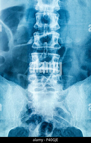 Wirbel Xray zeigt das Bauholz Wirbelsäule Stockfoto