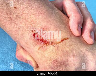 Hand, das verletzte Bein mit schmerzhaften statt. Arzt hand Heilung blutigen Bereich. Frische Abrieb. Tiefe Wunde auf der Haut. Stockfoto