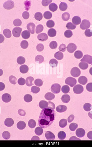 Rote Blutkörperchen mit spherocytosis Stockfoto