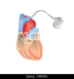 Herzschrittmacher in Arbeit. Menschliche Herz Anatomie Querschnitt mit Arbeiten implantierbarer Cardioverter/Defibrillator. Stock Vektor