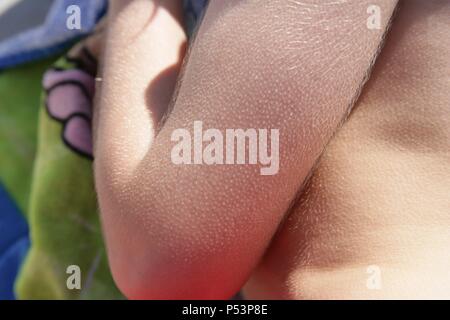 Gänsehaut auf einem menschlichen Arm. Stockfoto