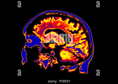 Eingefärbte MRT-Bild von Kopf, Gehirn Stockfoto