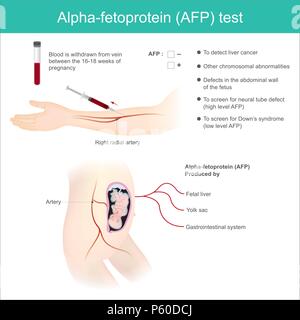 Alpha-fetoprotein (AFP) testen. Die Analysen auf der Ebene von AFP. Leberkrebs zu erkennen, und verwenden Sie für Down Syndrom. Stock Vektor