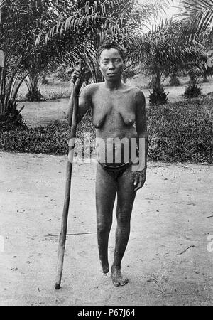 Amputation wurde häufig verwendet, um Arbeiter in den Kongo-Freistaat zu bestrafen;   gesteuert durch Leopold II von Belgien 1900 Stockfoto