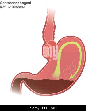 Gastroösophageale Refluxkrankheit GERD, auch als Acid Reflux genannt, ist eine langfristige Zustand, in dem Mageninhalt in die Speiseröhre kommen Resultat Stock Vektor
