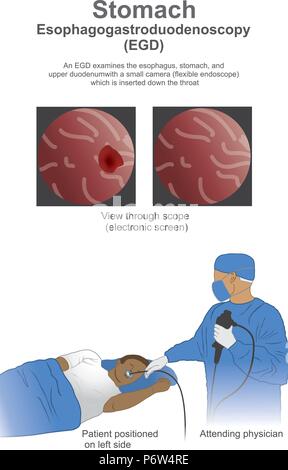 Esophagogastroduodenoscopy EGD ist ein Test die Auskleidung des Ösophagus, Magen, zu prüfen und im ersten Teil des Dünndarms. Stock Vektor