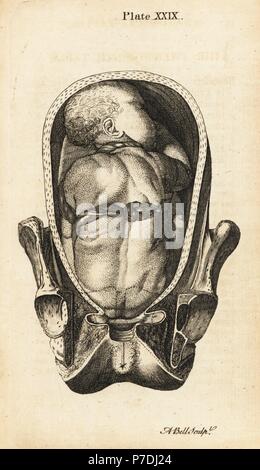 Fetus in Steißlage Geburt Position mit der Nabelschnur um den Hals, Arme und Körper. Kupferstich von Andrew Bell nach einer Illustration von Jan van Rymsdyk von William Smellie eine Reihe von anatomischen Tabellen, Charles Elliot, Edinburgh, 1780. Stockfoto