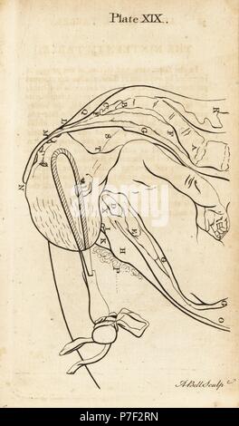 Fetus Kopf brachte unten im Geburtskanal mit Zange. Kupferstich von Andrew Bell nach einer Illustration von Jan van Rymsdyk von William Smellie eine Reihe von anatomischen Tabellen, Charles Elliot, Edinburgh, 1780. Stockfoto