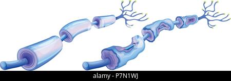Menschliche Nerven Zelle und periphere Neuropathie Abbildung Stock Vektor