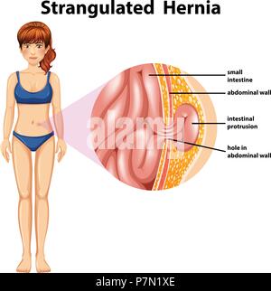 Frau stranguliert Hernie Diagramm Abbildung Stock Vektor