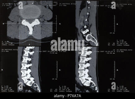 Männliche Wirbelsäule Röntgen Stockfoto