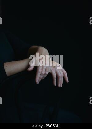 Vitiligo kosmetischen defekt Stockfoto