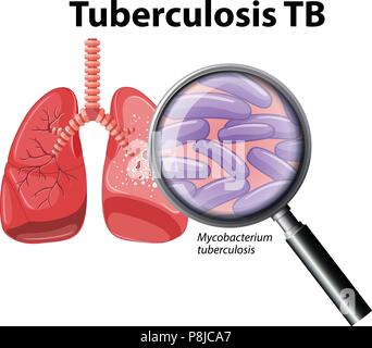 Menschliche Lunge mit Tuberkulose Abbildung Stock Vektor