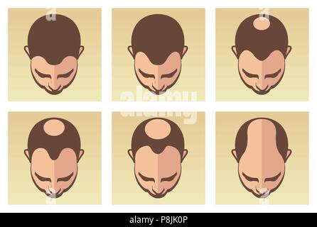 Ein Vektor Abbildung mit verschiedenen Phasen der männlichen Haarausfall. Stock Vektor