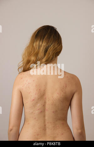 Junges Mädchen mit Akne, mit roten Flecken auf der Rückseite Stockfoto