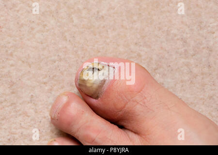 Nahaufnahme der kranke Männer Fuß Daumen Nagel, Pilzinfektionen der Nägel. Stockfoto