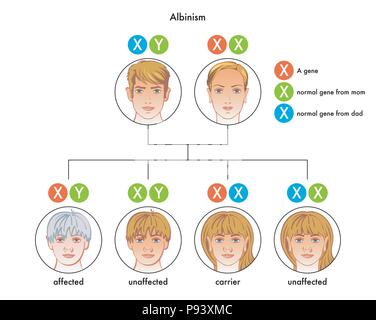 Vektor medizinische Illustration des albinismus Diagramm Stock Vektor