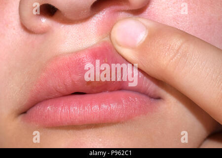 Herpes an der Lippe Stockfoto