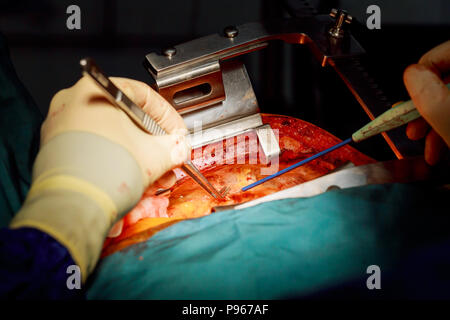 Medizinische team von Chirurgen in Krankenhäusern eingesetzt chirurgische Instrumente zur Chirurgie für die Behandlung in Operationssaal Nahaufnahme Stockfoto