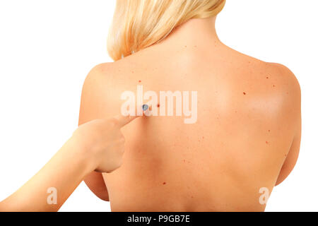 Weibliche Seite zeigt Großes Muttermal auf der weiblichen zurück. Behandlung von Muttermalen, Warzen, Papillome Stockfoto