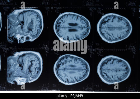 Kopf MRT. MR-Bild des menschlichen Gehirns Stockfoto