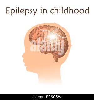 Kindheit Epilepsie, Illustration. Elektrische in einem Gehirn Entlastung. Stockfoto