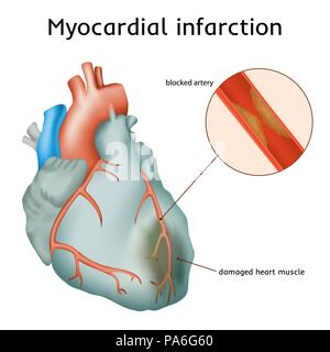 Herzinfarkt (Myokardinfarkt), Illustration. Eine blockierte Koronararterie hat zum Herzmuskel Schäden geführt. Stockfoto