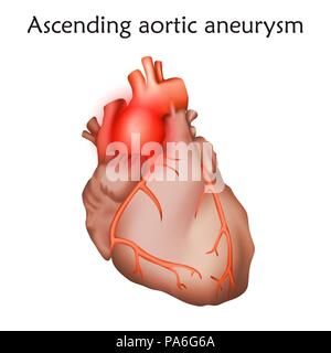 Aufsteigend Aortenaneurysma, Illustration. Die Erweiterung eines geschwächten Bereich in der Aorta ascendens. Stockfoto