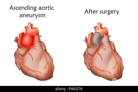 Aufsteigende Aorta Aneurysma vor und nach der Reparatur mit einem Rohr Graft, Illustration. Stockfoto