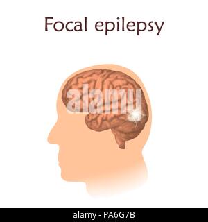 Fokale Epilepsie, Illustration. Elektrische in einem fokussierten Bereich des Hirns. Stockfoto