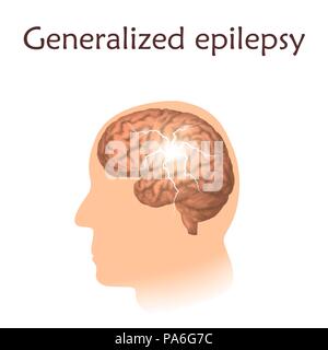 Generalisierte Epilepsie, Illustration. Elektrische im gesamten Gehirn eines Mannes. Stockfoto