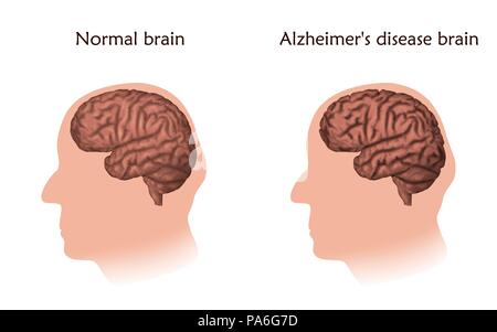 Alzheimer, Abbildung. Vergleich von einem normalen im Alter von Gehirn und das Gehirn eines Menschen mit Alzheimer. Stockfoto