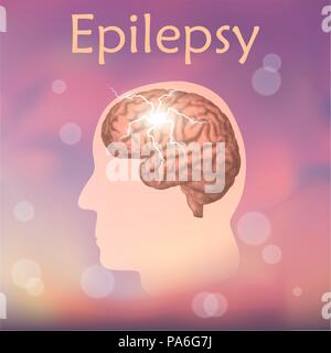 Epilepsie, Illustration. Elektrische im Gehirn des Menschen. Stockfoto